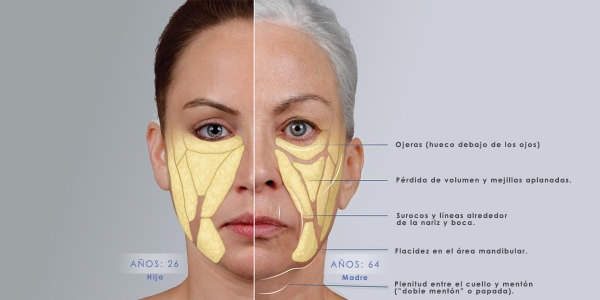 Tratamiento De La Flacidez Facial Y En Envejecimiento. - Consulta Del ...